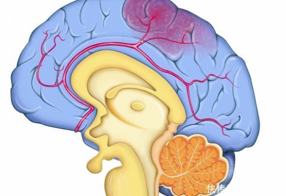 做好|50岁后血管开始老化,不想脑出血,这3件事应该重点做好