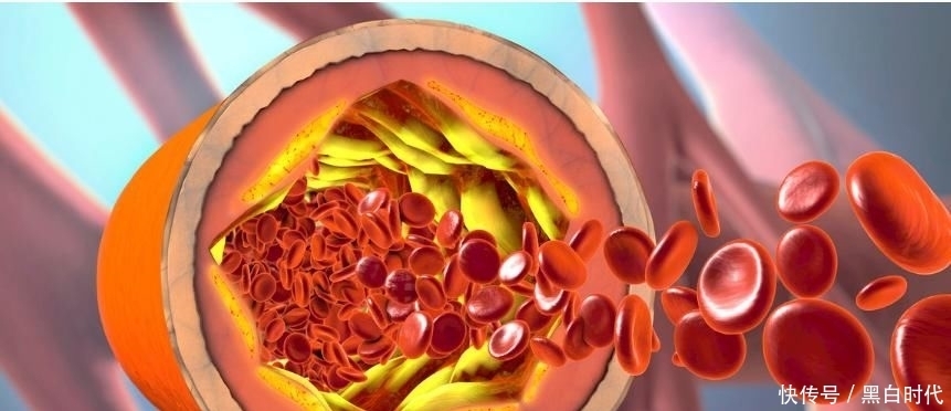 心脑血管|医生提醒:开水里加1勺,清理血管垃圾、降血脂,防心脑血管疾病