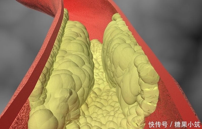 多试试|高血脂的“天敌”被找到,血脂高的人多试试,帮你刮掉血管里的油