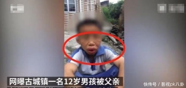 活该|12岁男孩被爸爸“揍成香肠嘴”，网友得知原因后真是活该