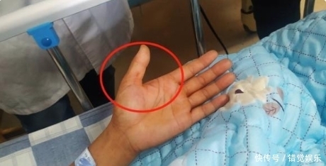 脑脊液|一女子在处理猪肉时被刺破手,患罕见疾病!全国仅见200多例
