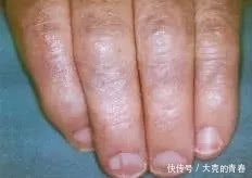 不好|肾不好,指甲知道?快对照着看看……