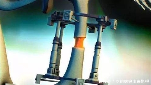 李亚诺|6年前,那个花16万,断骨增高7.2厘米高三男生,如今却后悔了