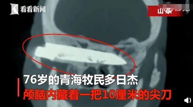 无感|老人遭歹徒抢劫被捅，10厘米尖刀藏脑内26年！因无感把这事忘了……