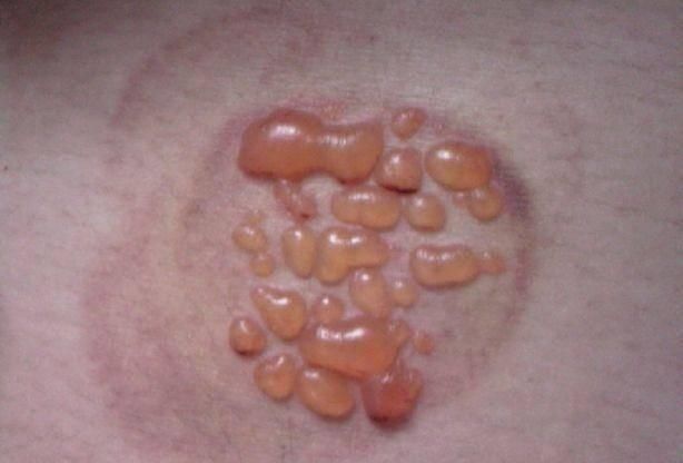 拔罐拔出的淤血和水泡,真的是体内的毒素吗