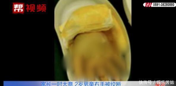  医生|家长来医院竟带着一只两岁男童的右手？在场所有人都惊呆了！