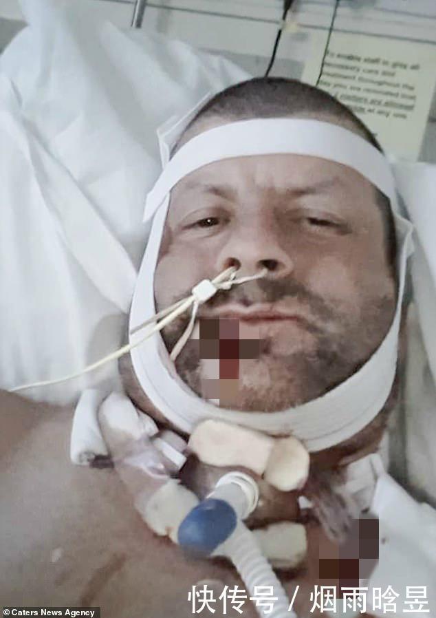  恐惧|英男子恐惧看牙医，27年后终做检查：下巴长拳头大肿瘤被迫摘除